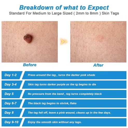 Auto Skin Tag Remover Painless | Skin Tag Removal Kit Adult Mole Wart Remover