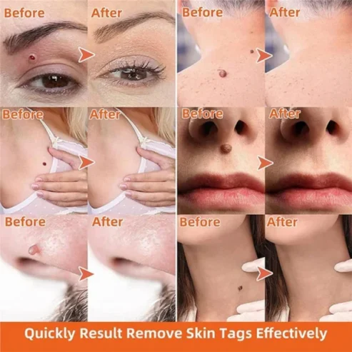 Auto Skin Tag Remover Painless | Skin Tag Removal Kit Adult Mole Wart Remover